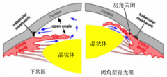 兰州爱尔眼科医院韦萍院长科普：青光眼七大误区 你有了解么？