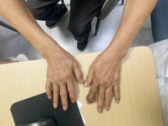 痛风只是短期问题，止痛就可以了吗？