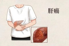 乙肝与肝癌