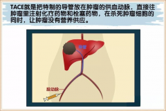 TACE和HAIC到底是什么？